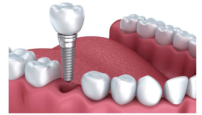 Phương pháp trồng răng Implant khắc phục tiêu xương răng