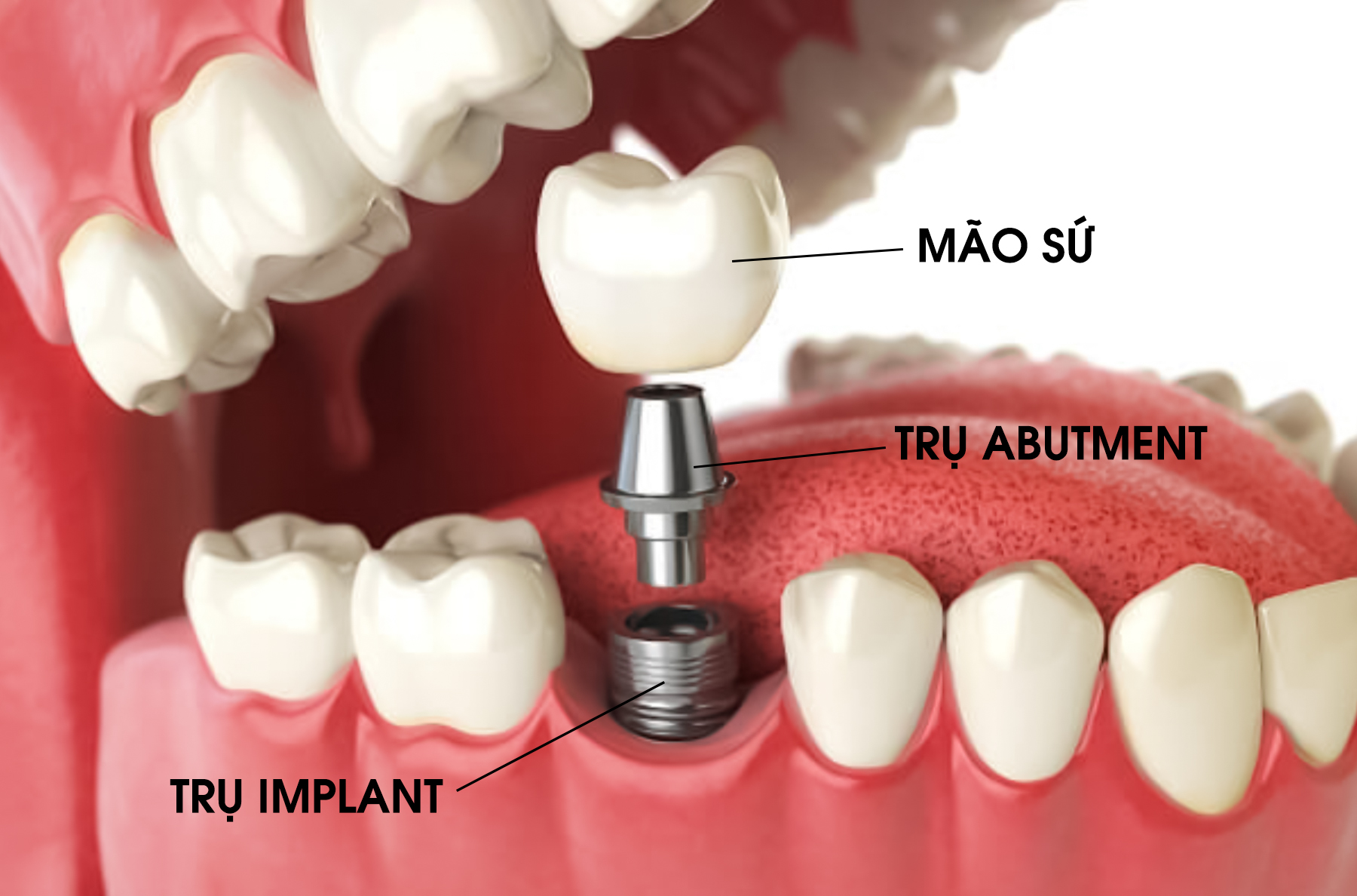 cac-phan-cau-tao-implant