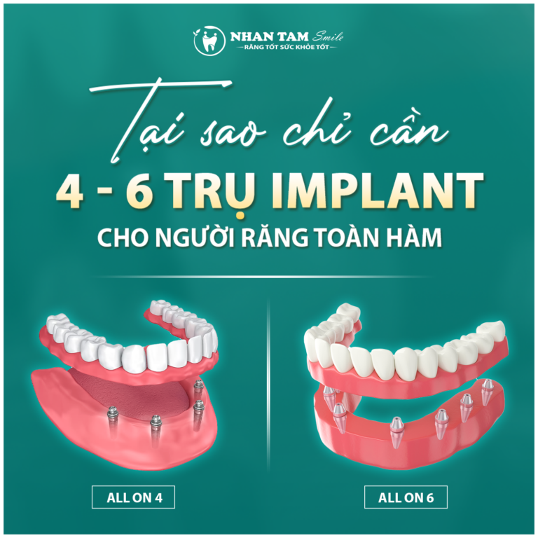 tai-sao-chi-can-4-6-tru-implant-toan-ham